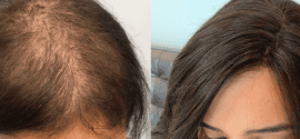 Does Cancer Cause Hair Loss Before Treatment