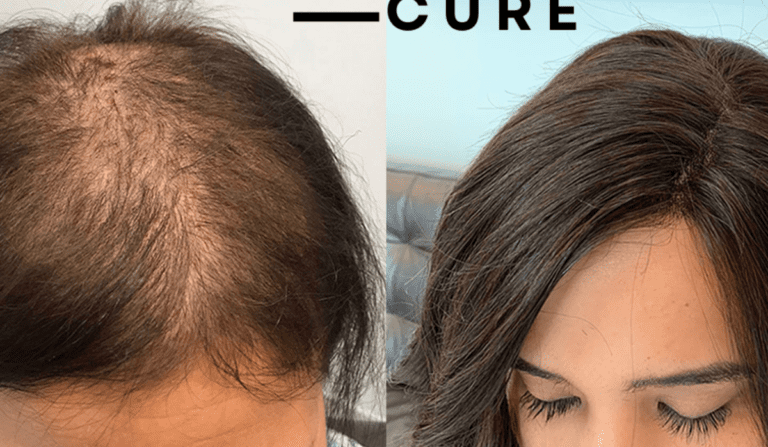 Does Cancer Cause Hair Loss Before Treatment