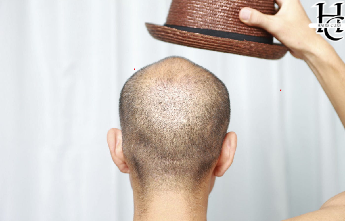 Do Hats Cause Hair Loss