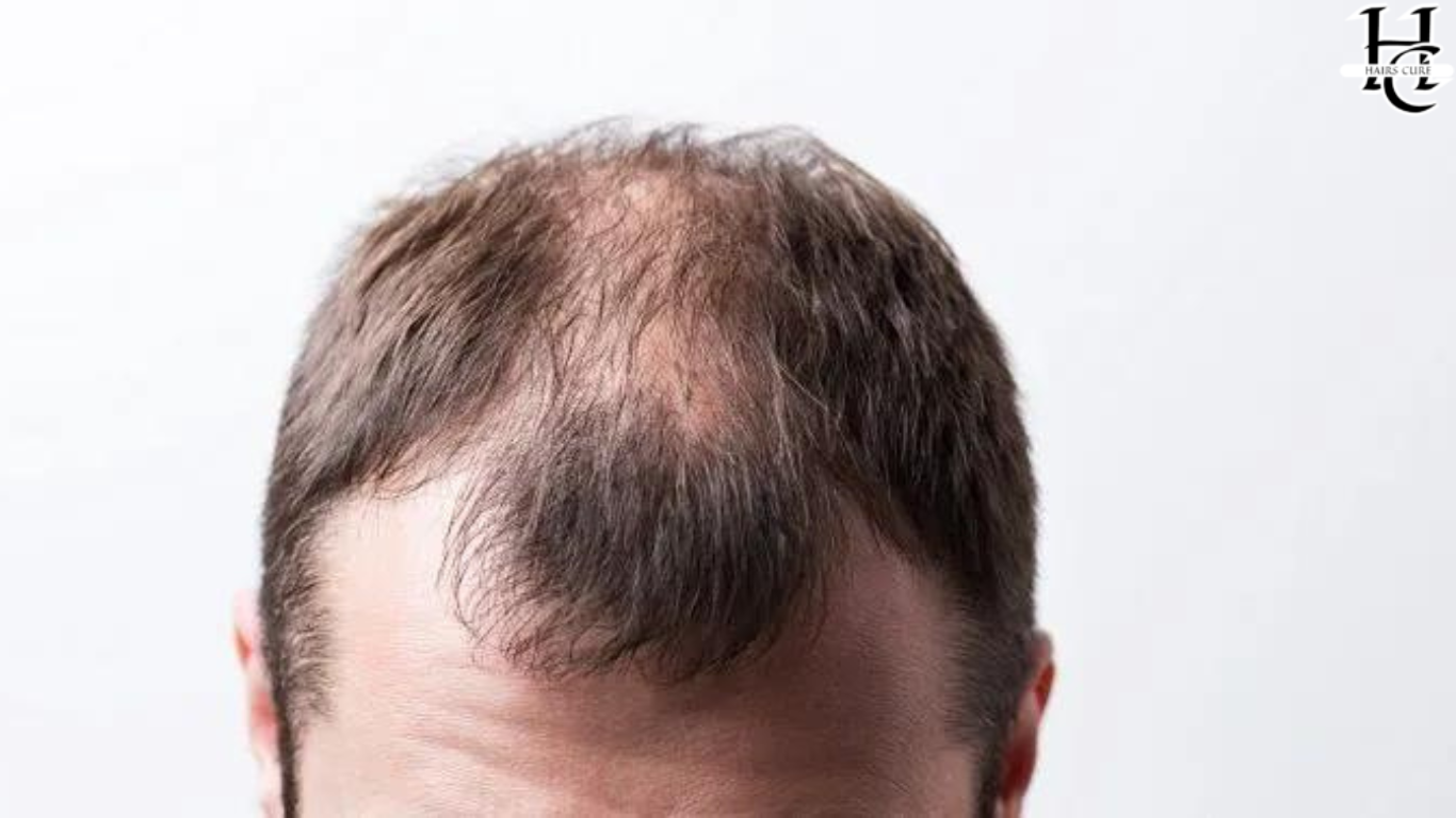 Haircuts for a Balding Crown